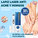 Lapiz Laser Azul Anti Hongos y Acne Import !